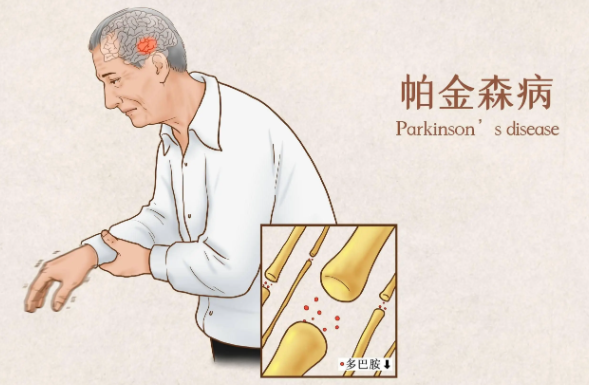 全面了解帕金森<span style="color: #da4707">综合症</span>：诊断、分期及治疗管理