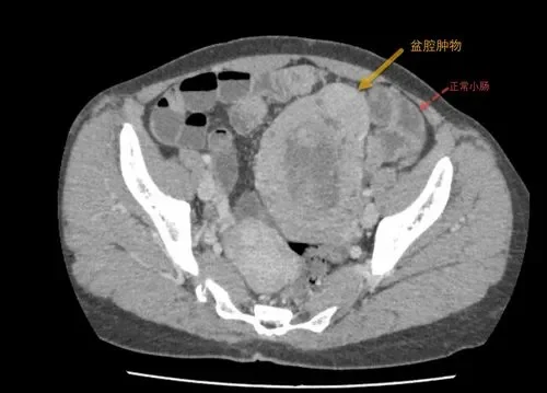 小肠间质瘤的诊断与治疗