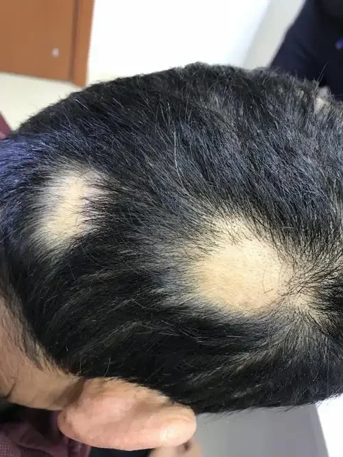 掉头发和过敏?这些皮肤问题你得注意了