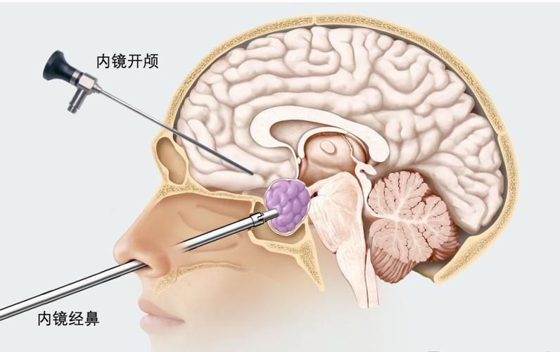 74岁老年患者头晕头痛，视物模糊半年——垂体瘤来袭，您应了解的那些事！