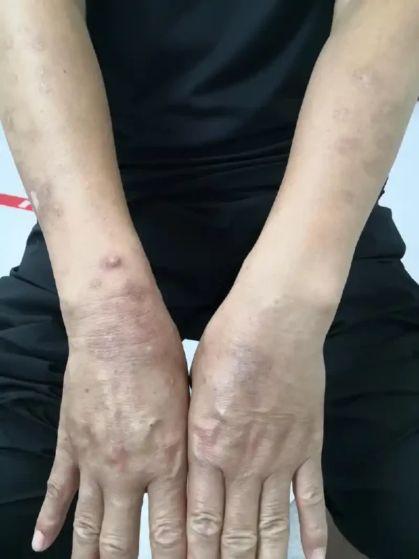 湿疹的困扰，你了解多少？——从症状到预防详解析！