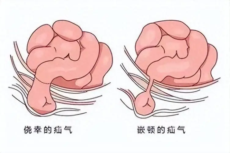年过六旬也不怕——如何有效治疗和预防<span style="color: #da4707">疝气</span>！