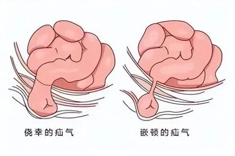 年过六旬也不怕——如何有效治疗和预防疝气！