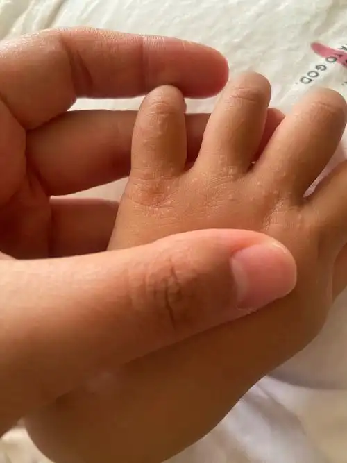 了解<span style="color: #da4707">接触性皮炎</span>：如何预防与管理