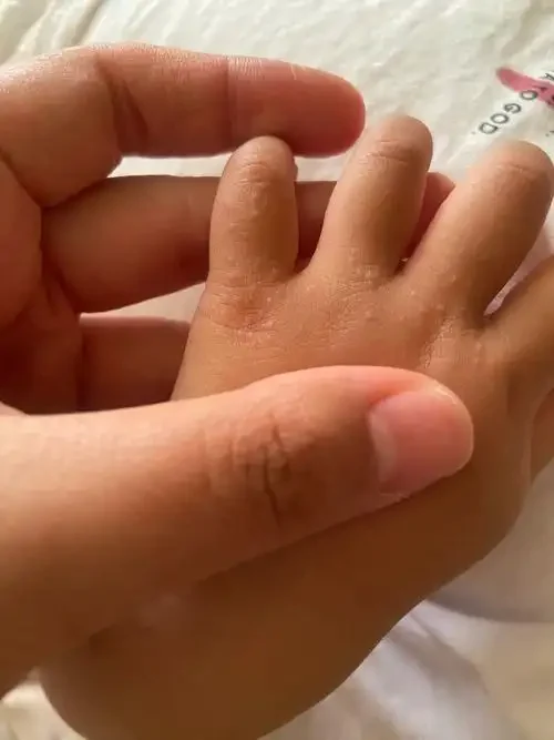 了解接触性皮炎:如何预防与管理