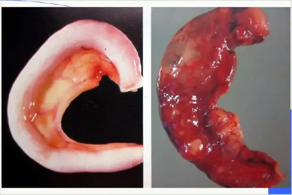 急性阑尾炎的早期识别与合理治疗——守护健康的关键!