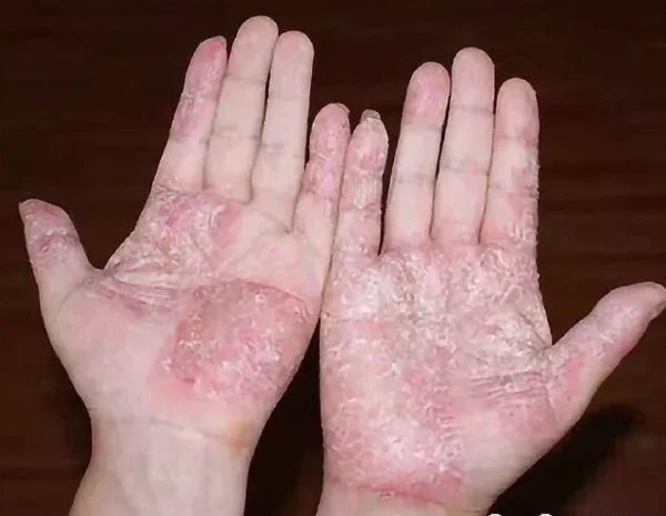 左手拇指红斑、丘疱疹：手癣和慢性荨麻疹的识别与预防
