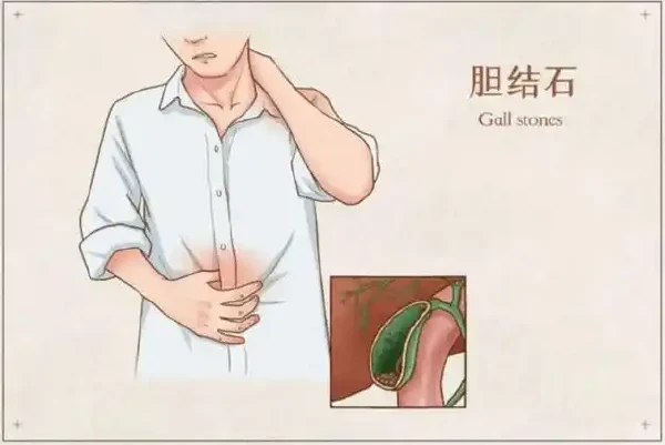 胆囊结石伴慢性胆囊炎:疾病管理及手术治疗