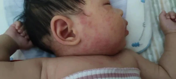 宝宝脸上的湿疹是什么？你必须要知道的那些事！