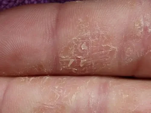 角化性湿疹:从病因到管理的全面解析