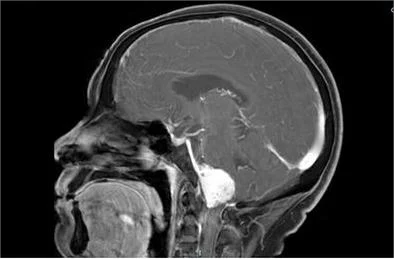 枕骨大孔区肿瘤性病变:诊断与治疗全解析