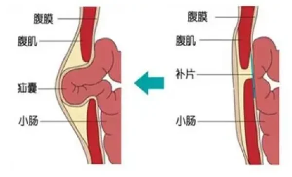 腹股沟疝修补术究竟有多重要?不容忽视!