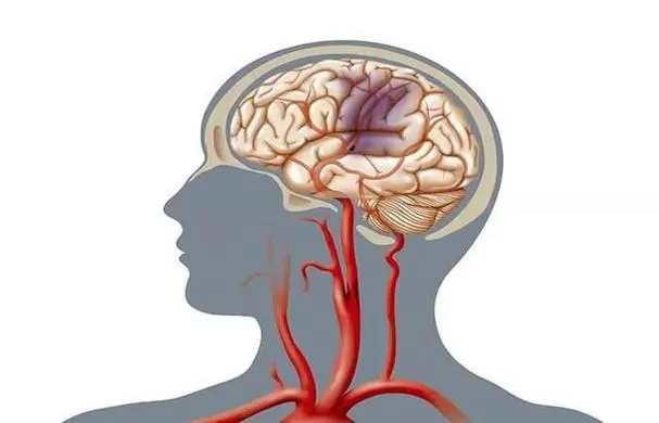 脑动脉供血不足与管理：你需要知道的一切