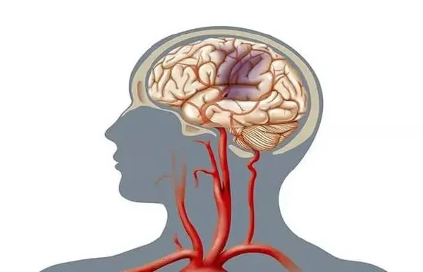 脑动脉供血不足与管理：你需要知道的一切