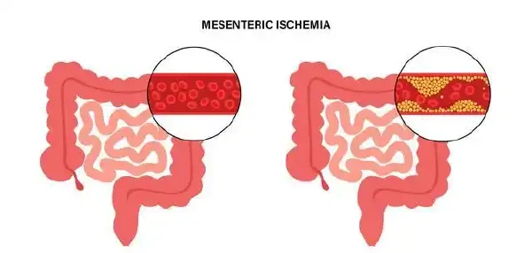 健康报告警报!需要知道的缺血性肠病和其他疾病的真相