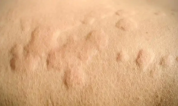 荨麻疹突然来袭？了解急性荨麻疹，远离皮肤之痒！