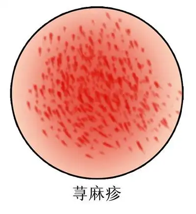 <span style="color: #da4707">摆脱</span>慢性<span style="color: #da4707">荨麻疹</span>困扰：详解诊断、治疗与预防