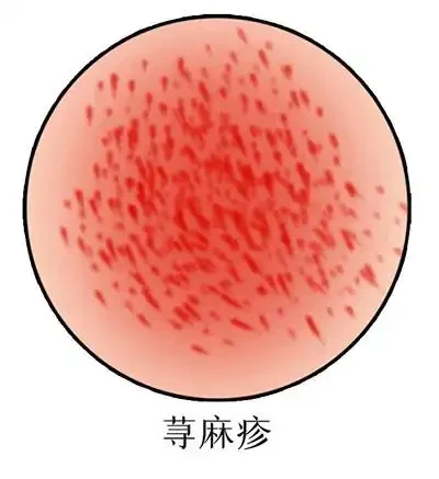 摆脱慢性荨麻疹困扰:详解诊断、治疗与预防
