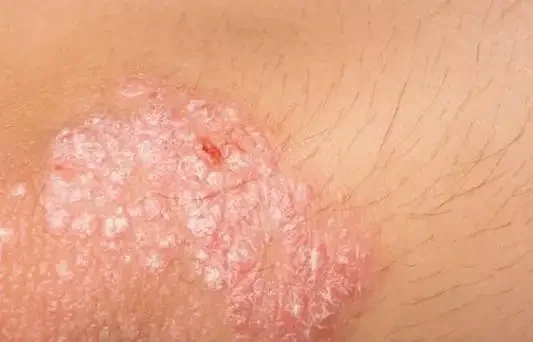 神经性皮炎的早期症状与防治