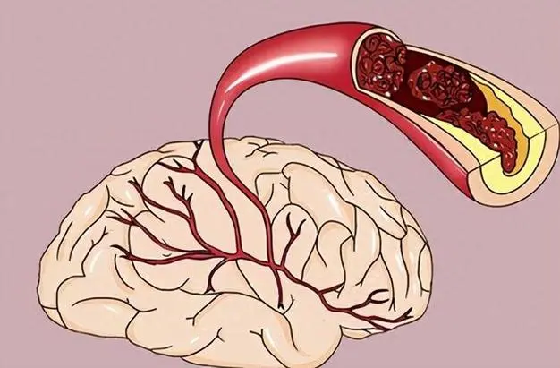 全面解析脑血管供血不足：类型、诊断与治疗