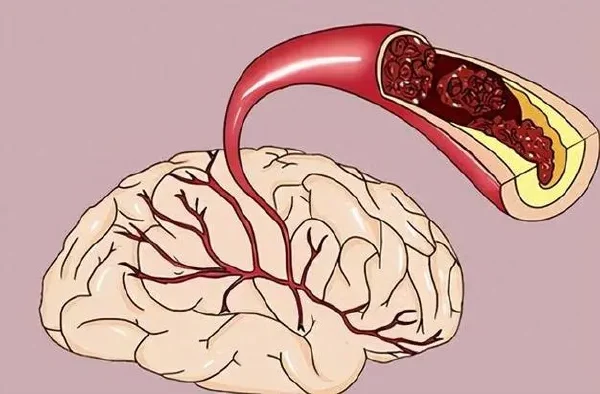 全面解析脑血管供血不足:类型、诊断与治疗