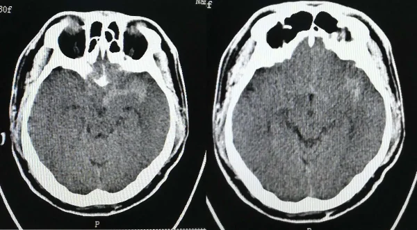 蛛网膜下腔出血与高血压：了解病因与预防措施