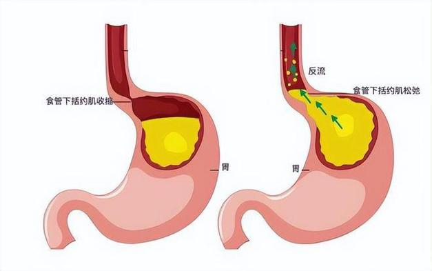 胸痛、咳嗽还有隐情？——了解反流性食管炎的真相！