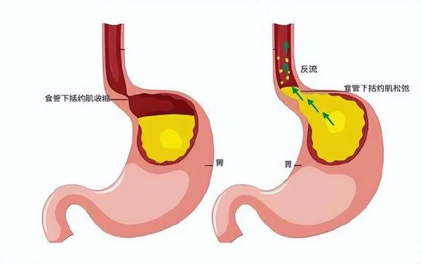 胸痛、咳嗽还有隐情？——了解反流性食管炎的真相！