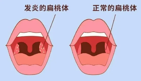 全面解读扁桃体炎和变应性鼻炎：从诊断到治疗 - 健康科普、医学科普、中医科普、儿童科普、科普中国