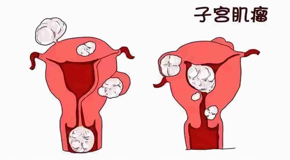 揭秘子宫肌瘤：女<span style="color: #da4707">性健康</span>的隐形威胁