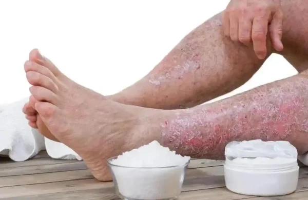 湿疹不可怕——如何有效管理和预防湿疹