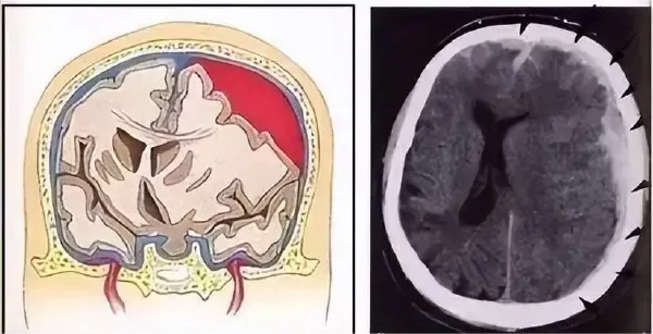 脑部创伤与硬膜下血肿:健康守护指南