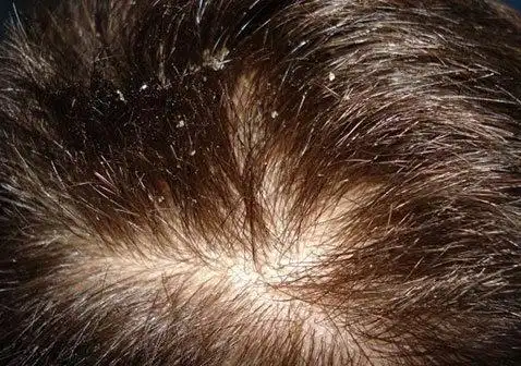 脂溢性皮炎：正确认识与科学管理封面图