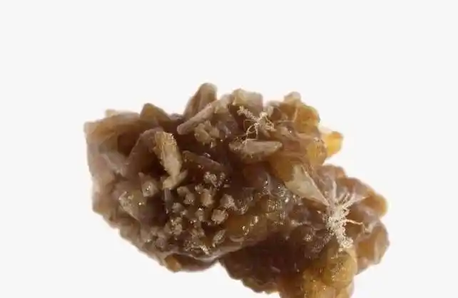 肾结石:从诊断到治疗的全面指南