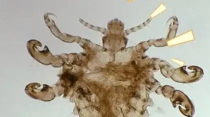 皮炎伴感染与阴虱病的防治指南