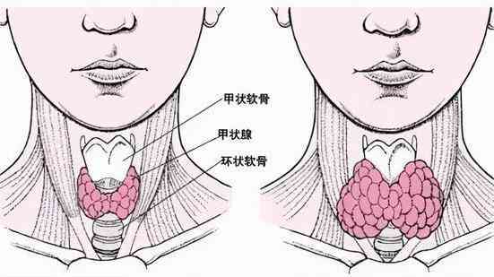 桥本<span style="color: #da4707">氏</span>甲状腺炎揭秘——隐形杀手！