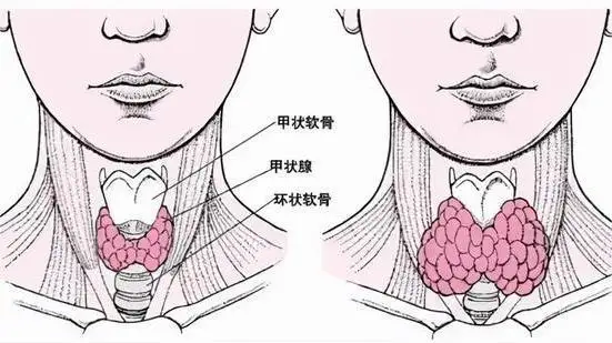 桥本氏甲状腺炎揭秘——隐形杀手！