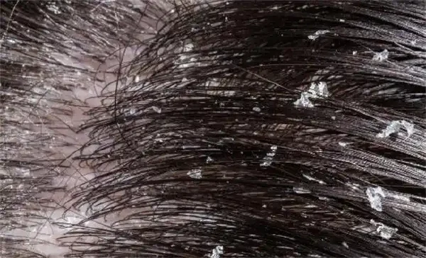 从头皮屑到健康头皮：脂溢性皮炎的防治指南