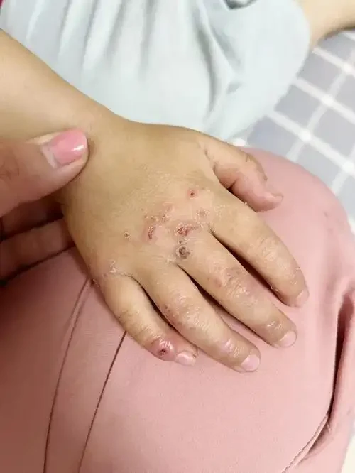 特应性皮炎知多少？—有效管理与预防指南