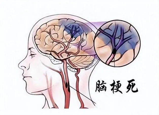 <span style="color: #da4707">脑梗死</span>：全面解析及科学<span style="color: #da4707">管理</span>