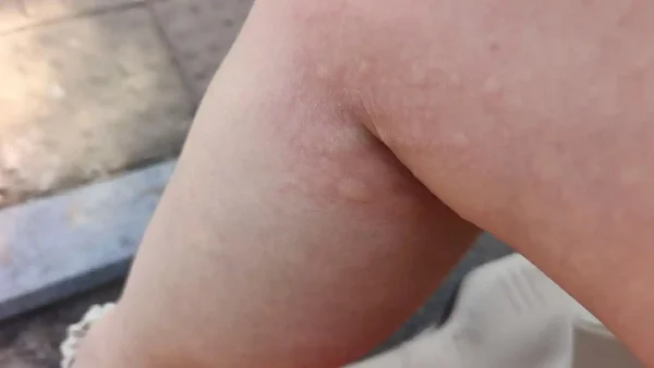 荨麻疹 — 你简直无法想象的瘙痒陷阱！
