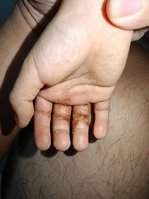 医生告诉你：如何预防和治疗湿疹