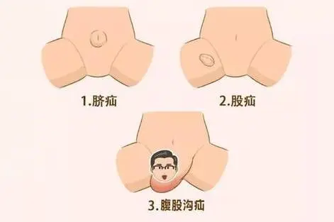 <span style="color: #da4707">疝气</span>困扰？——揭开<span style="color: #da4707">疝气</span>的神秘面纱