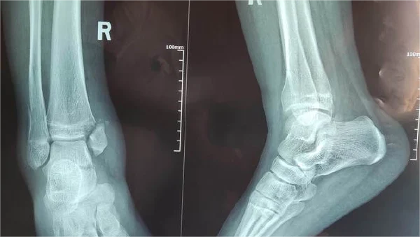 理解踝关节骨折：从诊断到恢复 - 健康科普、医学科普、中医科普、儿童科普、科普中国