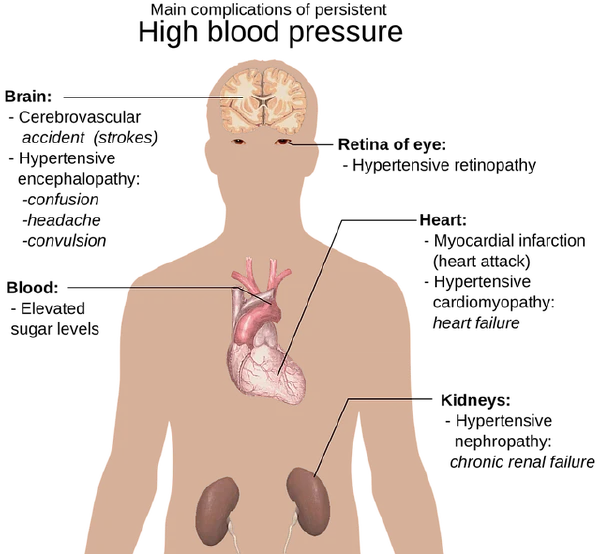 高血压:全面了解与管理