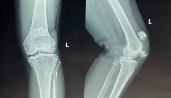 “老年运动意外:髌骨骨折知多少?”