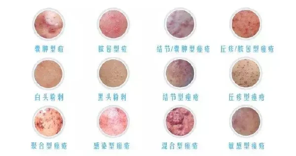 结节性痤疮:全方位解析及治疗策略