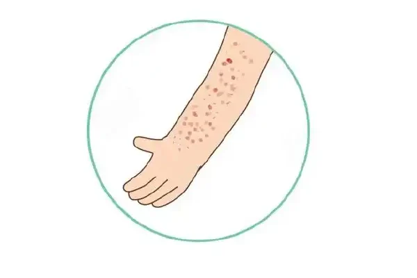 了解荨麻疹:从诊断到预防全解析