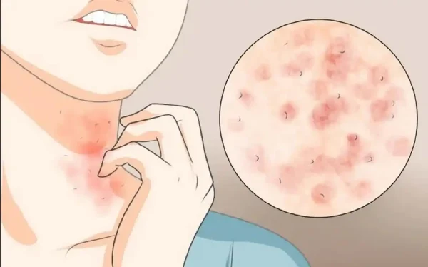 如何应对慢性荨麻疹和神经性皮炎?——老年女性的皮肤健康指南