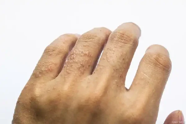 湿疹又来了！如何舒缓这个令人生厌的皮肤问题？